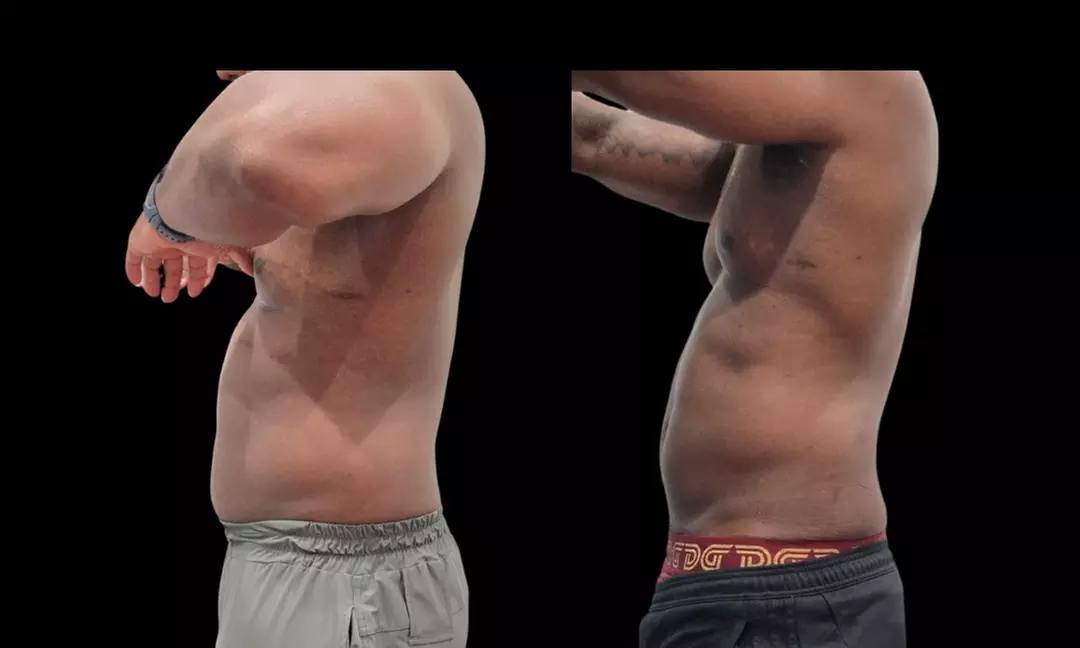 Two or Three Fat Dissolver Sessions or One Fat Dissolver and More
