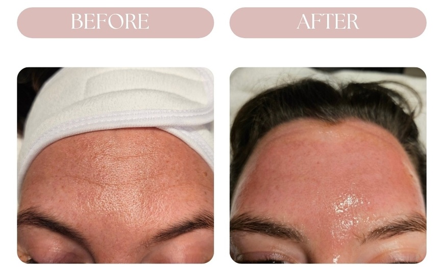 Image 5: Luxury Microneedling Facial or Microneedling Facial & Dermaplaning