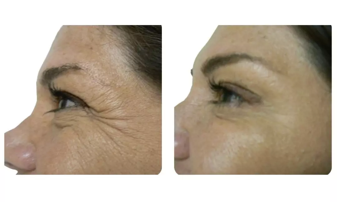 Refresh Yourself with Xeomin Shots