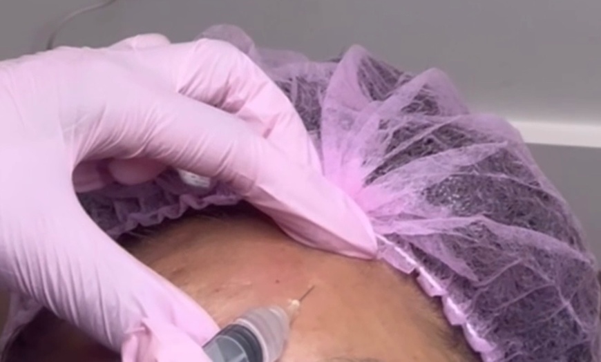 Image 1: Up to 35% Off on Micro-Needling at Diva Beauty SPA Lashes & Brows