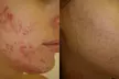 Up to 54% Off on One Acne, Melasma or Hyperpigmentation Face Peel at Mona Venus Advanced Skincare - Second Medium