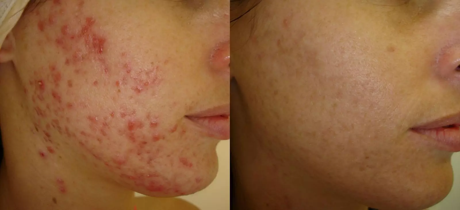 Up to 54% Off on One Acne, Melasma or Hyperpigmentation Face Peel at Mona Venus Advanced Skincare