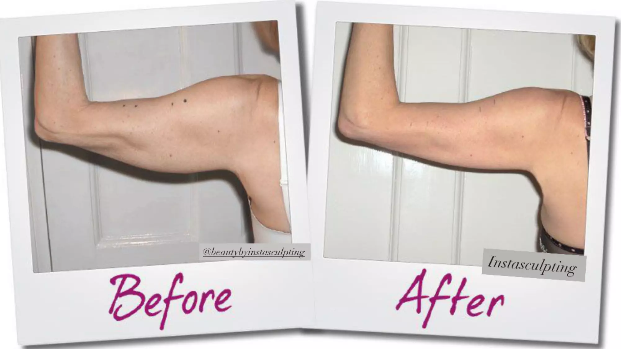 Achieve Your Ideal Shape with Non-Invasive Laser Lipo Sessions