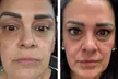 Transform Your Skin with One or Three CO2 Skin-Resurfacing Sessions at Amora Med Spa (Up to 77% Off) - Second Medium