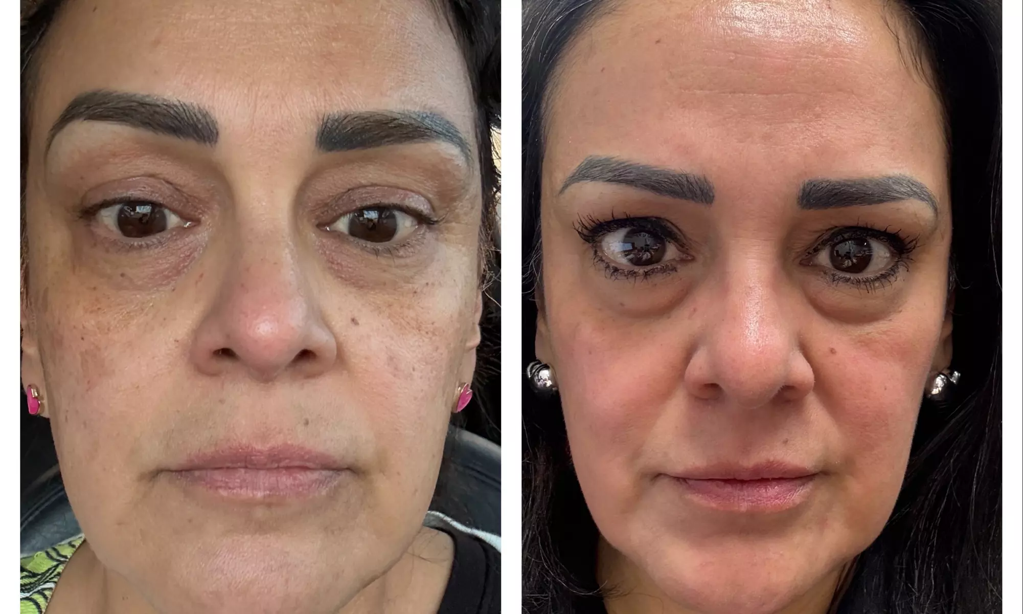 Transform Your Skin with One or Three CO2 Skin-Resurfacing Sessions