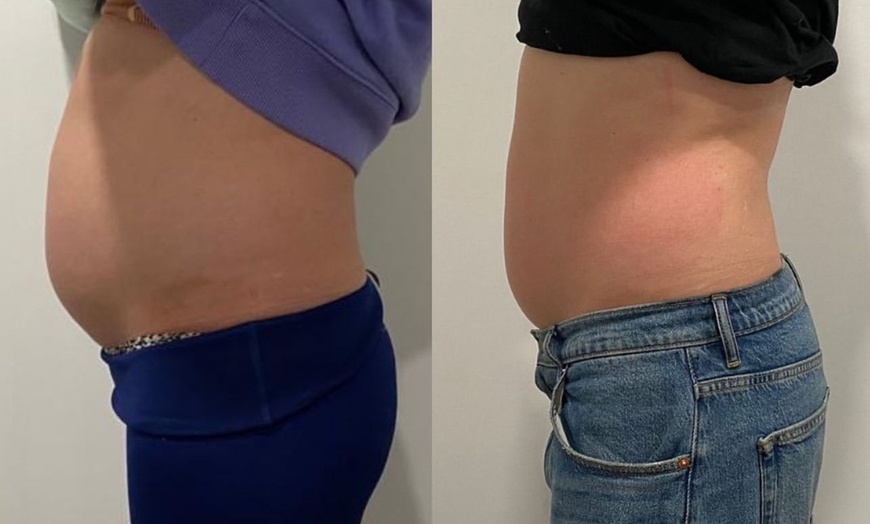 Image 1: Up to 57% Off on Ultrasonic Fat Reduction at ILLUME Skin Spa