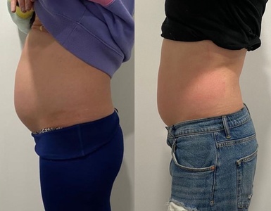 Two Ultra Cavitation with Laser Lipo - New Client - ILLUME Skin Spa