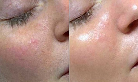 One 30-Minute Facial with Ultraceutical - A2Zen Wellness Center