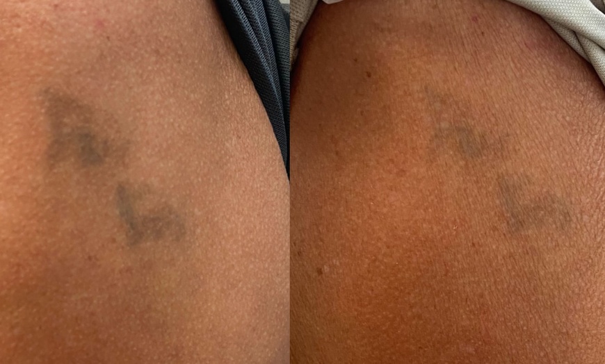 Image 4: Achieve Ink-Free Skin with Laser by Nicole's Tattoo Removal for All Sizes up to 39%