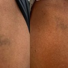 Image 4: Achieve Ink-Free Skin with Laser by Nicole's Tattoo Removal for All Sizes up to 39%