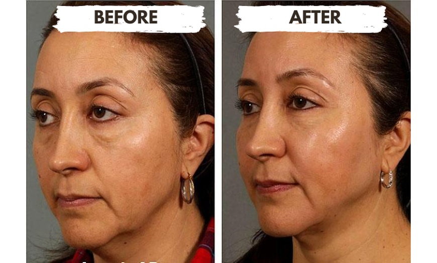 Image 3: 1/2, 1, 2, or 4 Vials of Sculptra Collagen-Stimulating Injectables