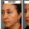 Image 3: 1/2, 1, 2, or 4 Vials of Sculptra Collagen-Stimulating Injectables