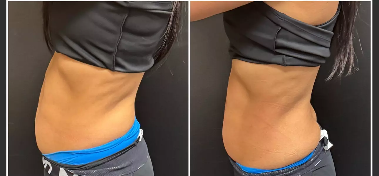 Up to 78% Off on Electrical Muscle Stimulation at Premier Body Shaping