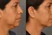 Enhance Your Look with One or Two Vials of Kybella at Clinical Care 365 (Up to 58% Off) - Second Medium