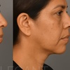 Image 3: Melt Stubborn fat with One or Two Vials of Kybella @ Clinical Care 365