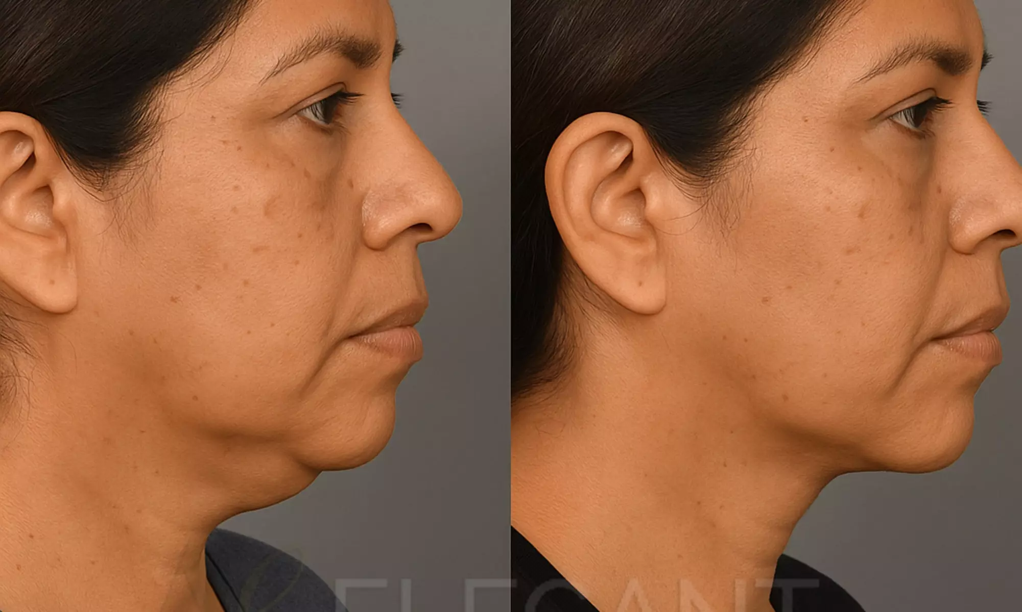 Enhance Your Look with One or Two Vials of Kybella