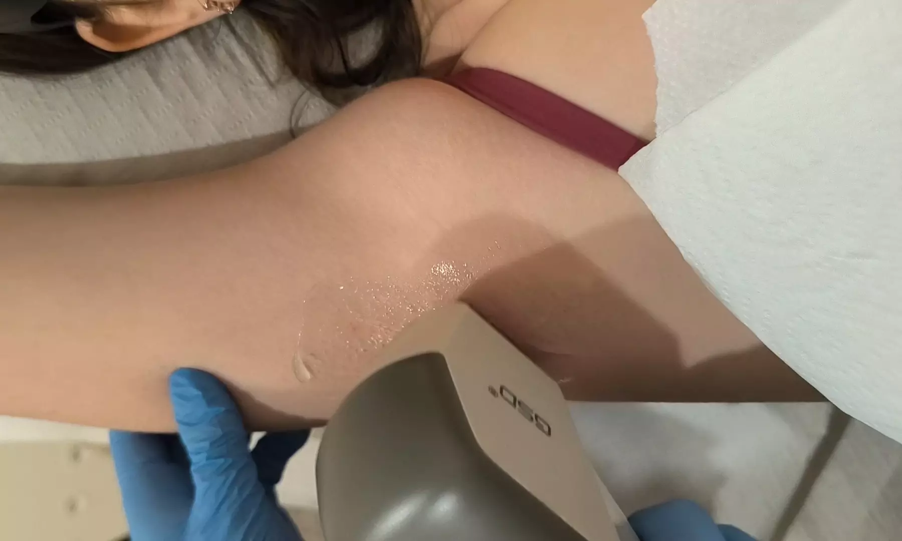 Depilacja laserowa wybranych obszarów