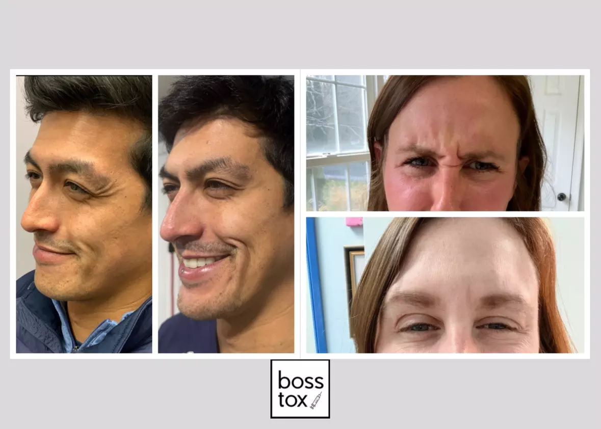 Refresh Your Look with 10, 20, or 30 Units of Xeomin/Jeuveau