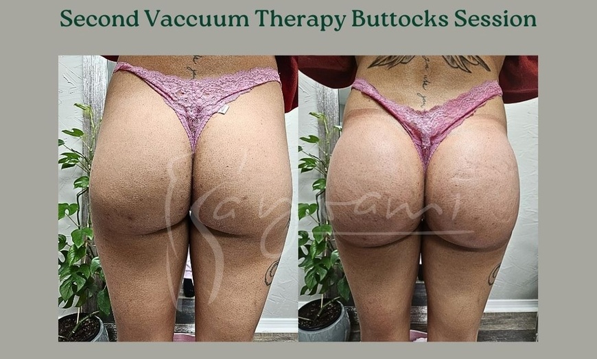 Image 8: Vacuum Therapy Buttocks & Body Enhancement or CryoStatic Slimming