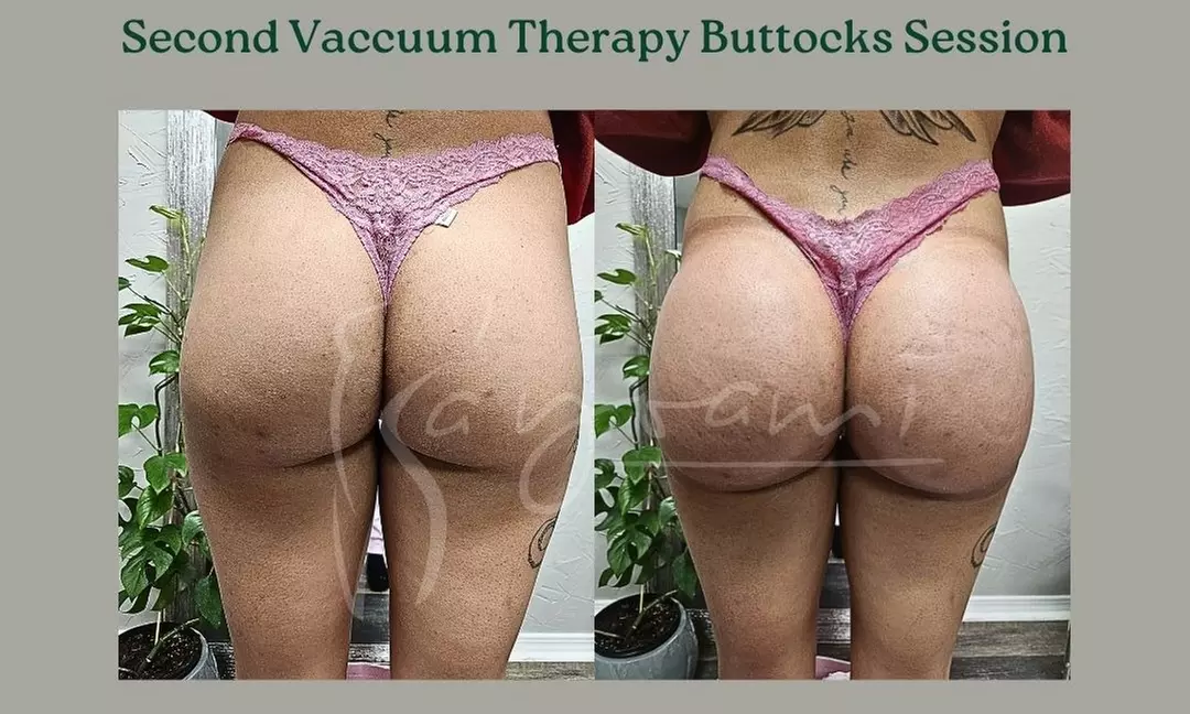 Vacuum Therapy Buttocks & Body Enhancement or CryoStatic Slimming