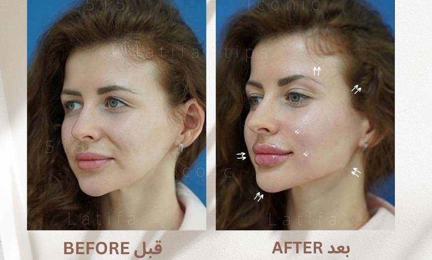 Image 13: Achieve a Natural Look with Dermal Filler 0.5ml, 1ml, or 2ml