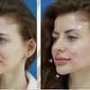 Image 13: Achieve a Natural Look with Dermal Filler 0.5ml, 1ml, or 2ml