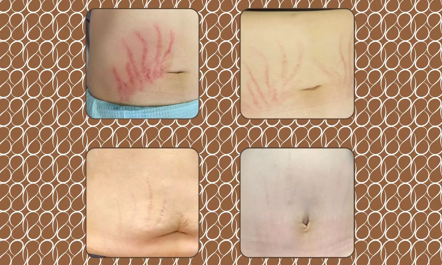 Three DermaLiss Stretch Mark Treatment Sessions – Small to XL Areas