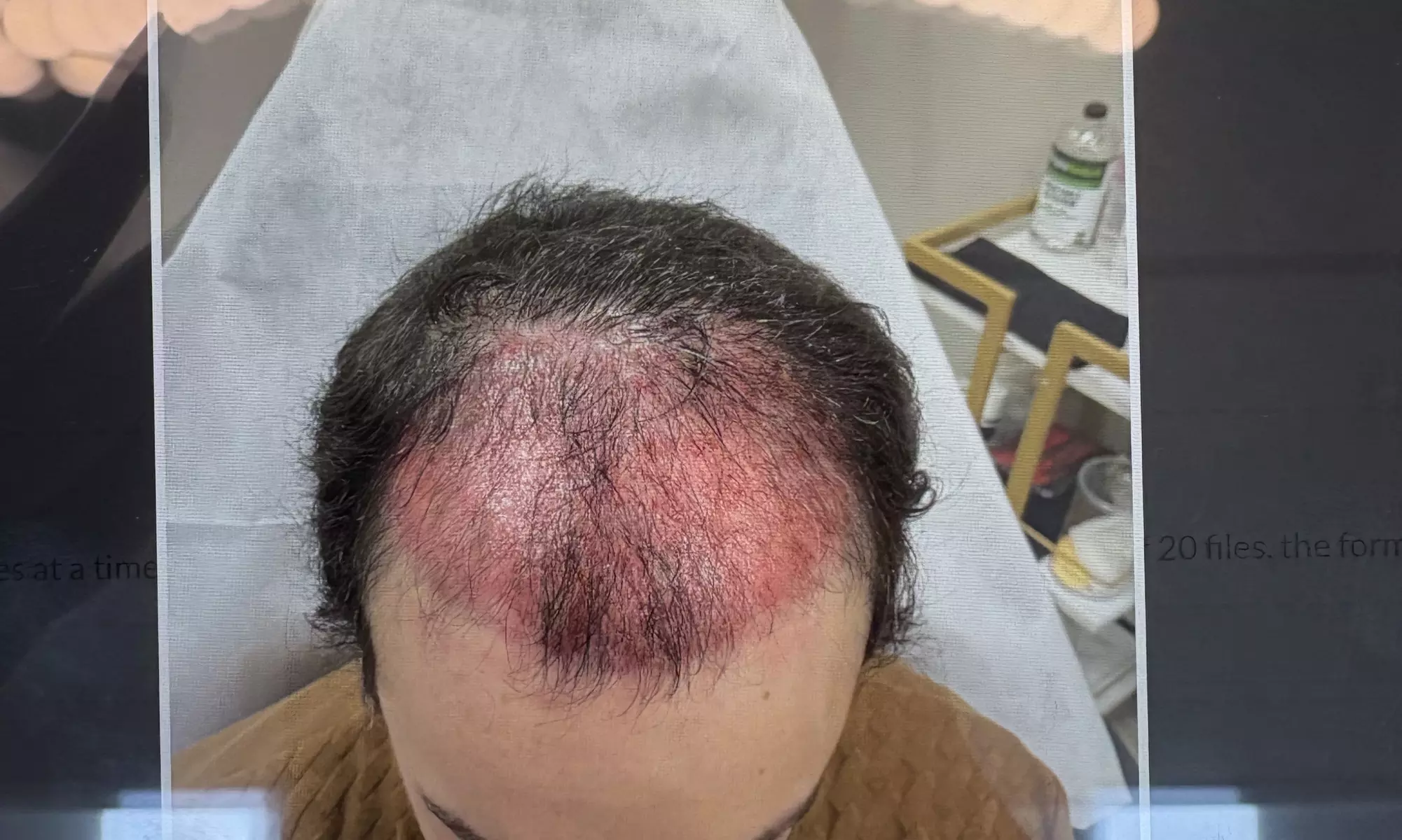Up to 55% Off on Hair Restoration - Non-Surgical at VC Esthetics