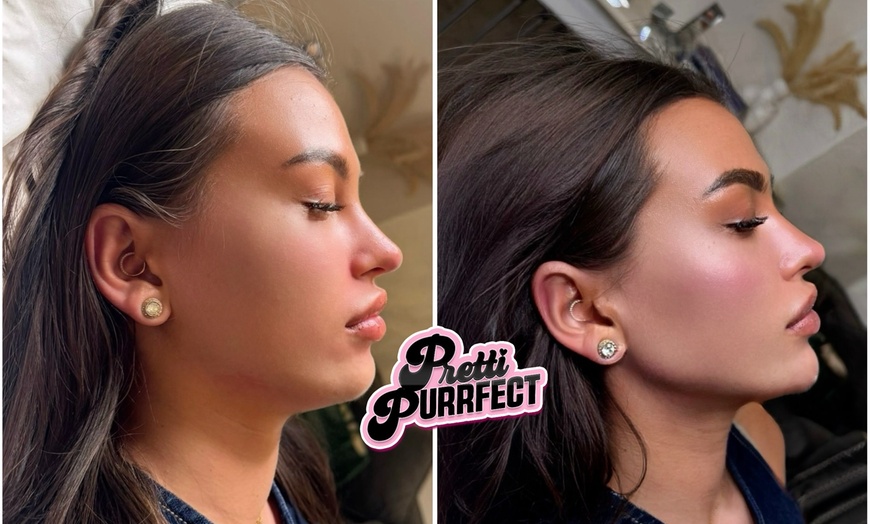 Image 4: Up to 68% Off on Injection - Dermal Filler at Pretti Purrfect