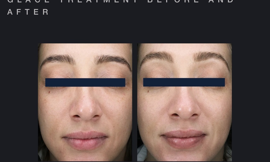 Image 4: Glow with One or Three Glacē™ Skin Treatments