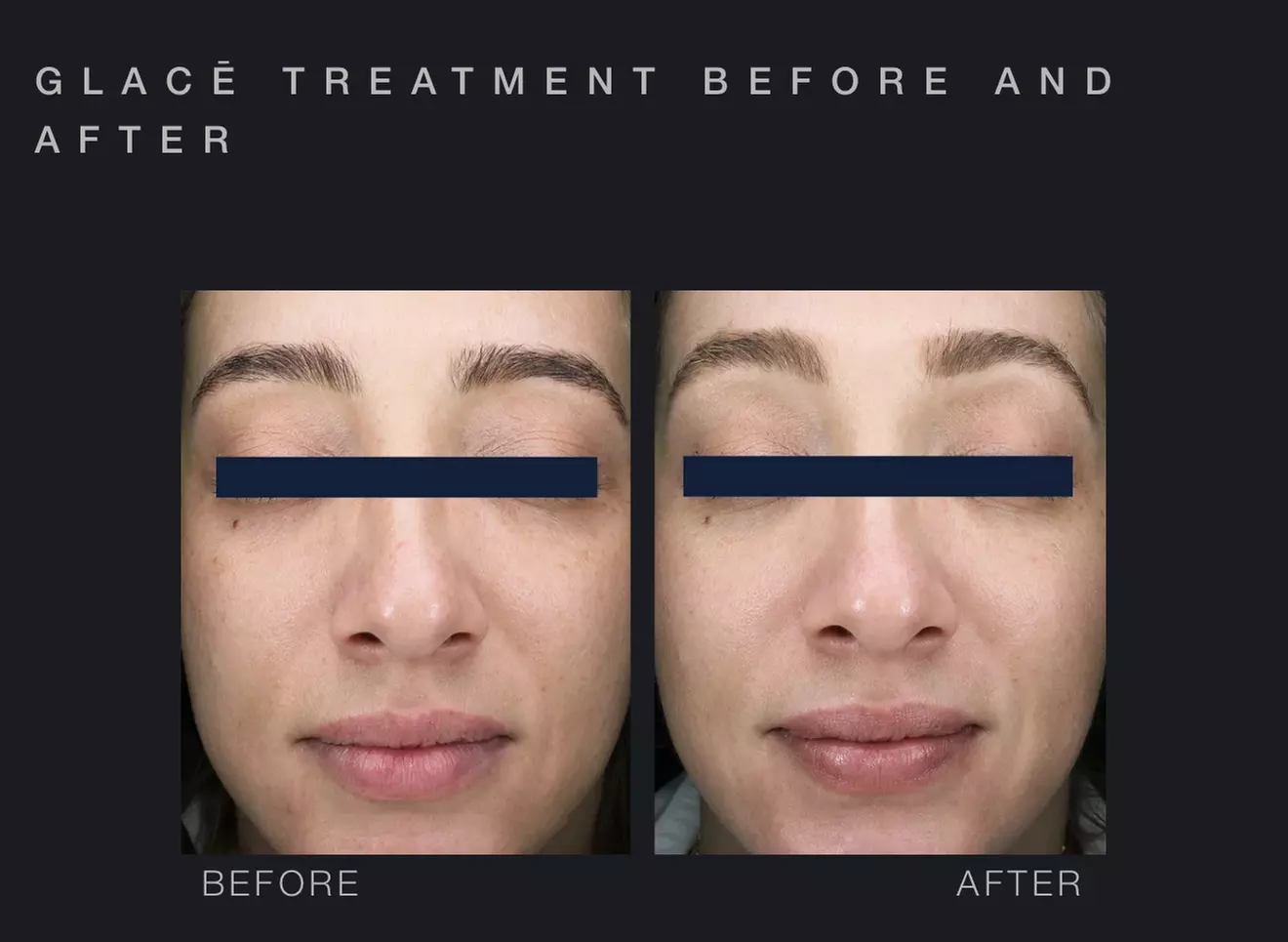 Glow with One or Three Glacē™ Skin Treatments