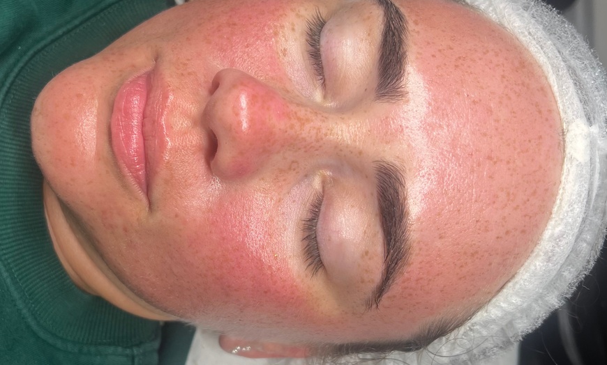 Image 7: Up to 59% Off on Facial - HydraFacial at RefreshSkinTherapy