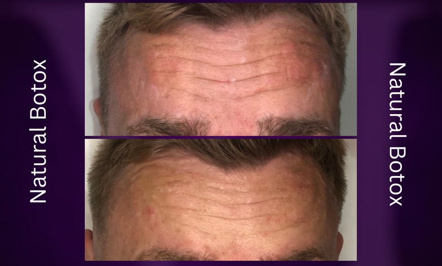 Image 4: Azzalure Skin Booster for Target Frown, Forehead & Eye Wrinkles 