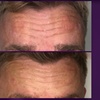 Image 4: Azzalure Skin Booster for Target Frown, Forehead & Eye Wrinkles 