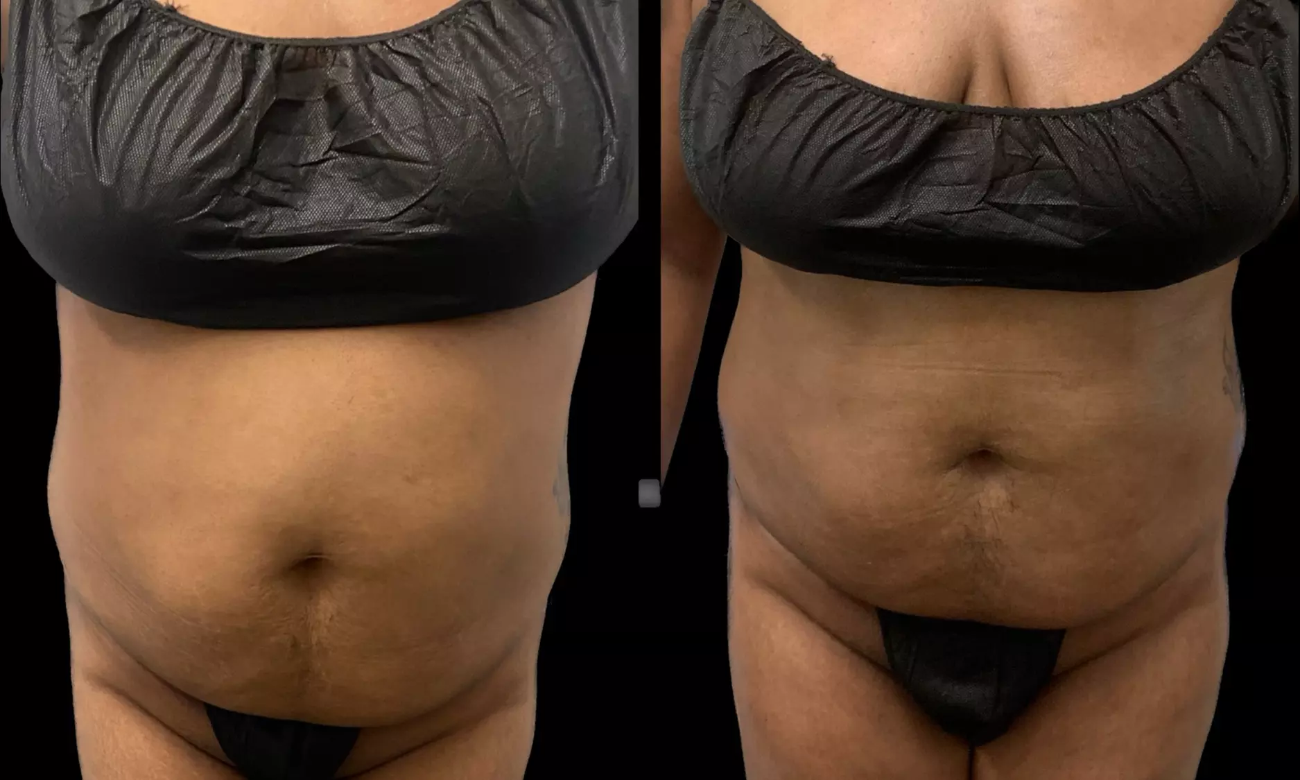 Experience the luxury of Lashay's Faces with two radio frequency body sculpting sessions at home, enjoying up to 50% off - Second Medium