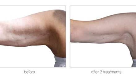 One Venus Versa Cellulite/ Skin Tightening /Fat Reduction Body Contouring for Arms/Neck/Bra Line/Buttocks/Flanks - Beauty Factory Boutique Spa