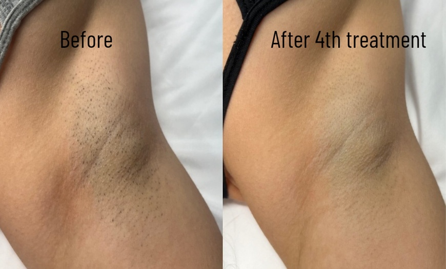 Image 6: Laser Hair-Removal Sessions on a Small, Medium or Large Area.