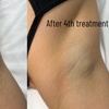 Image 6: Laser Hair-Removal Sessions on a Small, Medium or Large Area.