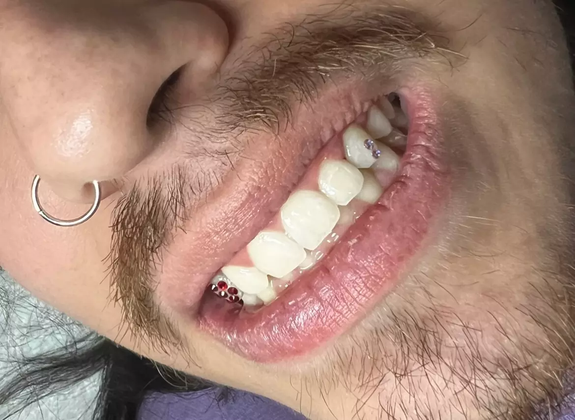 Sparkle up with One or Two Tooth Gems for a Bright Smile