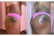 Experience Extreme Body Sculpting's innovative nonsurgical butt lifts with up to 56% off for stunning results - Second Medium