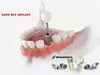 Dental Implant—including Bone Graft, Implant, and Abutment Crown at Smile Dental Care—50% Off