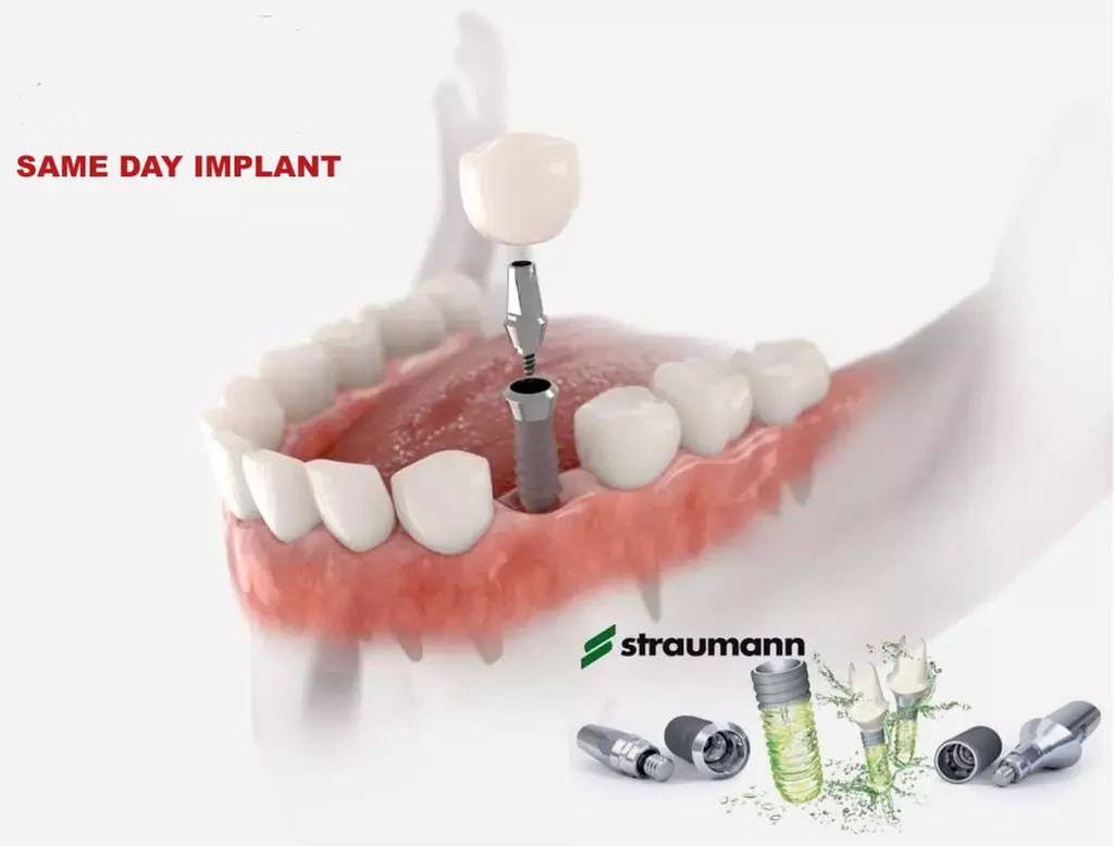 Dental Implant—including Bone Graft, Implant, and Abutment Crown