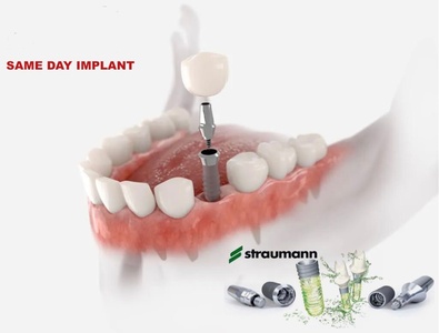 Dental Implant - including Bone Graft, Implant, and Abutment Crown - Smile Dental Care