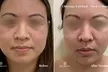 Up to 64% Off on Ultherapy / Ultrasonic Facial at One Beauty Aesthetics - Second Medium