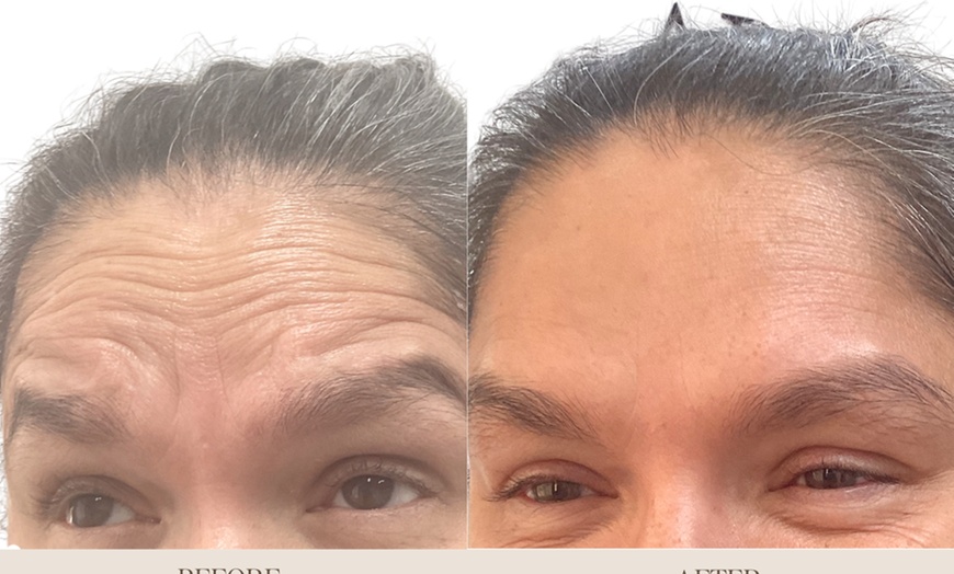 Image 2: Achieve a Youthful Glow: 20 Units of Jeuveau, Lip Flip, or Brow Lift