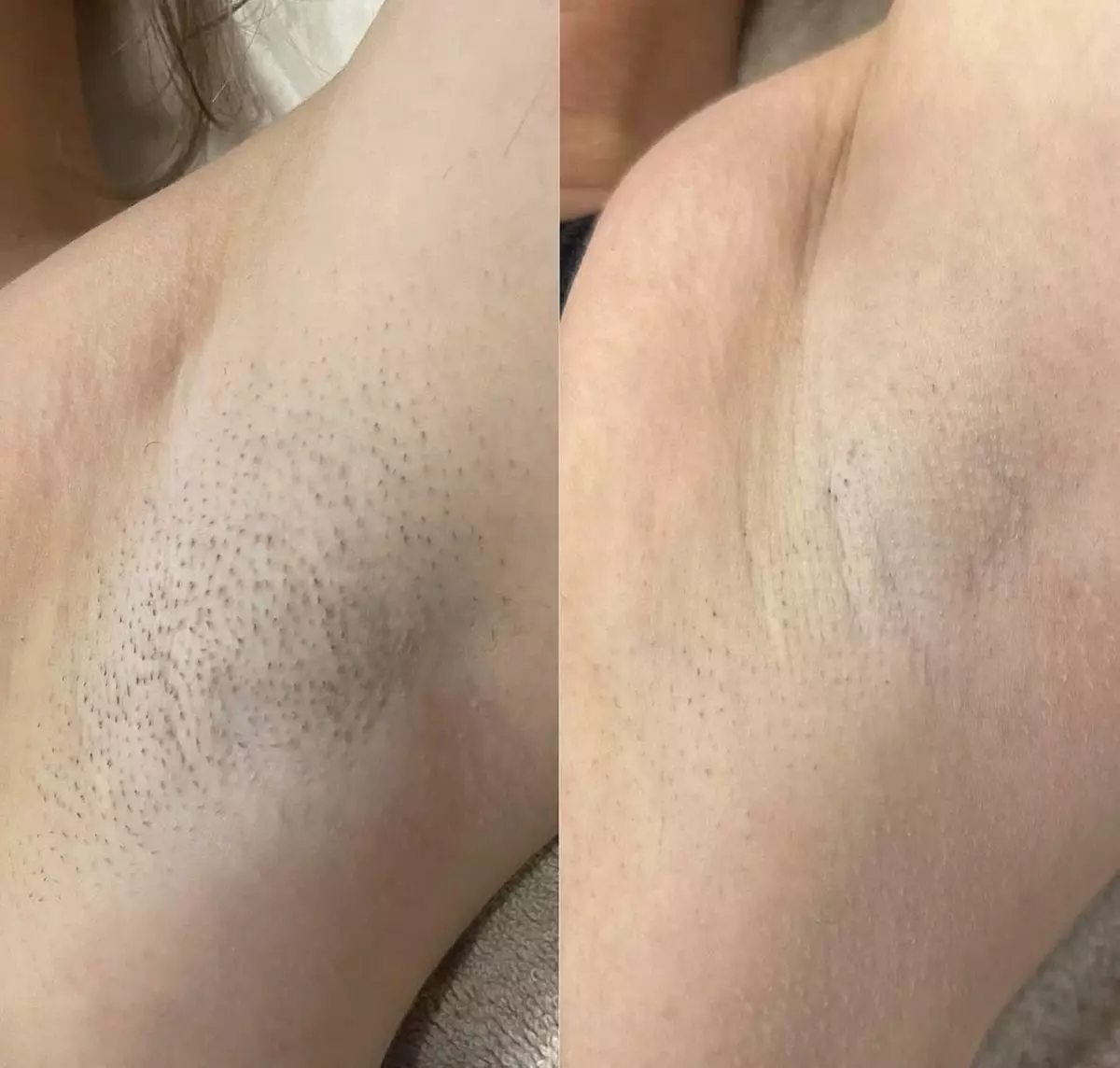 8 Laser Hair Removal Sessions on One Small, Medium, or Large Area (Up to 60%)