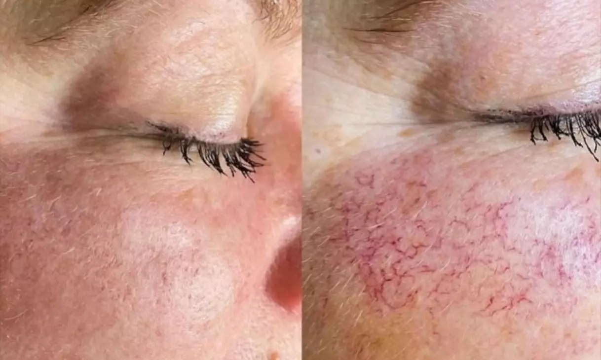 Advanced Thread Veins & Spider Naevi Removal Treatment for Face at aesthetic zone (Up to 65% Off) - Second Medium