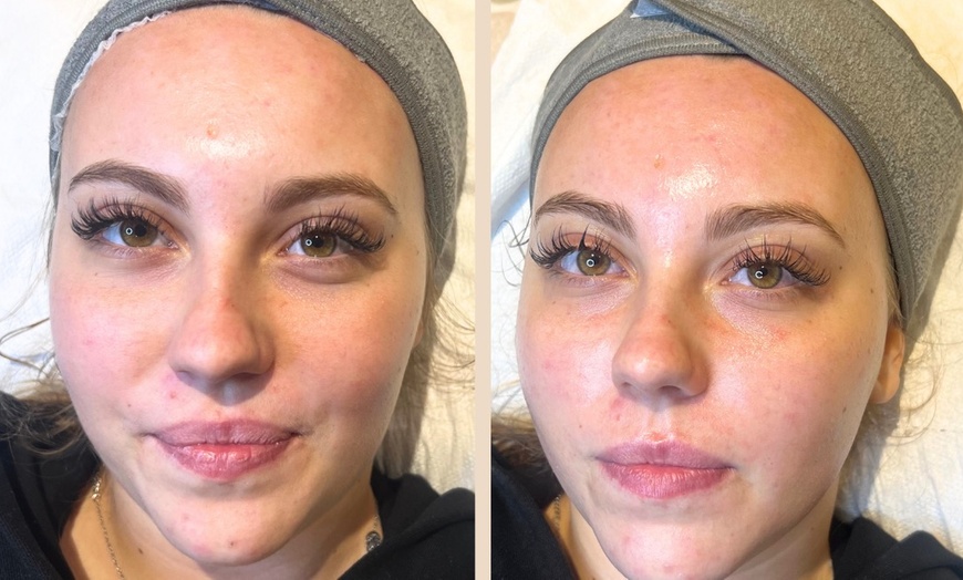 Image 1: Refresh Your Glow with Hydro-Facial, Dermaplane, or Microneedling