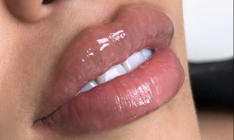 1mL Dermal Filler for Plumper Lips, Contoured Cheeks, or Defined Jaw