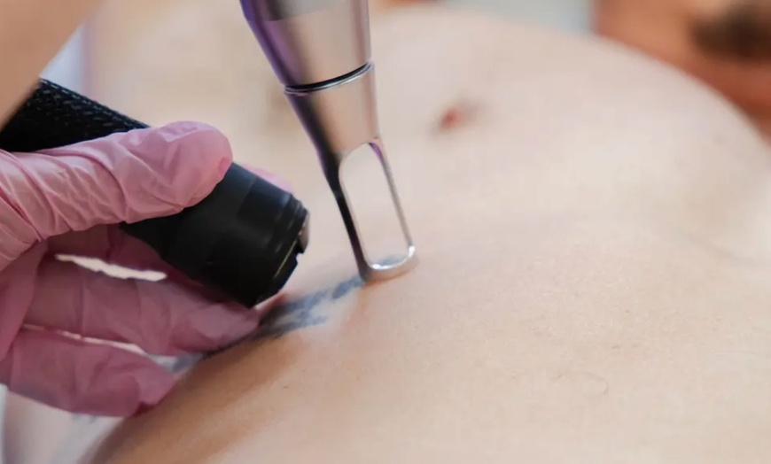 Image 2: Achieve Ink-Free Skin with Laser by Nicole's Tattoo Removal for All Sizes up to 39%